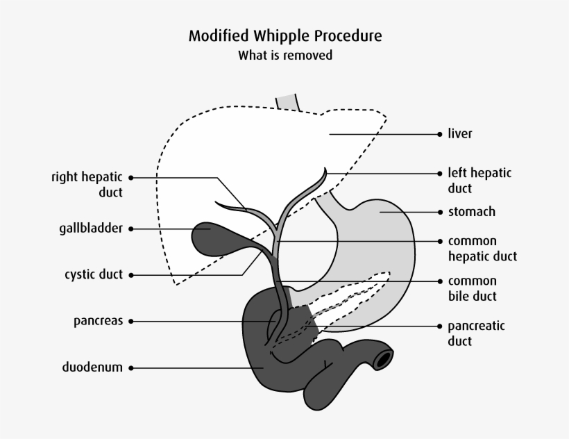 Diagram Of What Is Removed In A Modified Whipple Procedure - Modified Whipple Procedure, transparent png #10061025