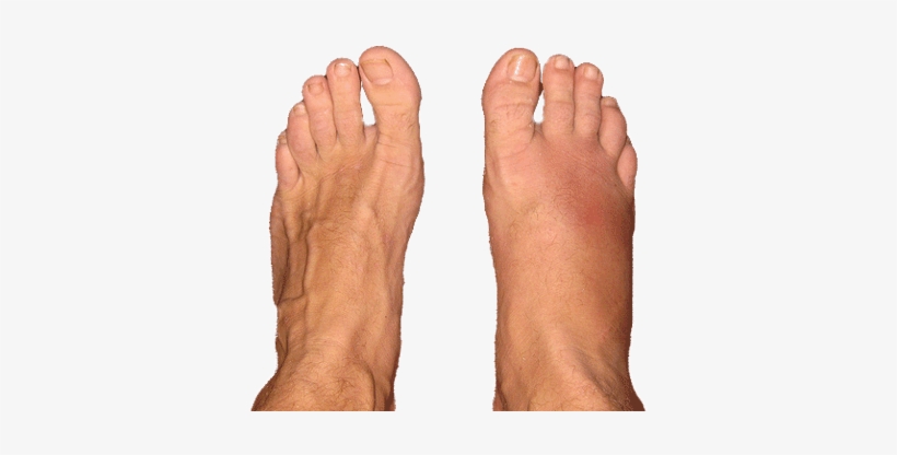 Edema Or Swollen Feet - Stress Fracture Foot, transparent png #1041656