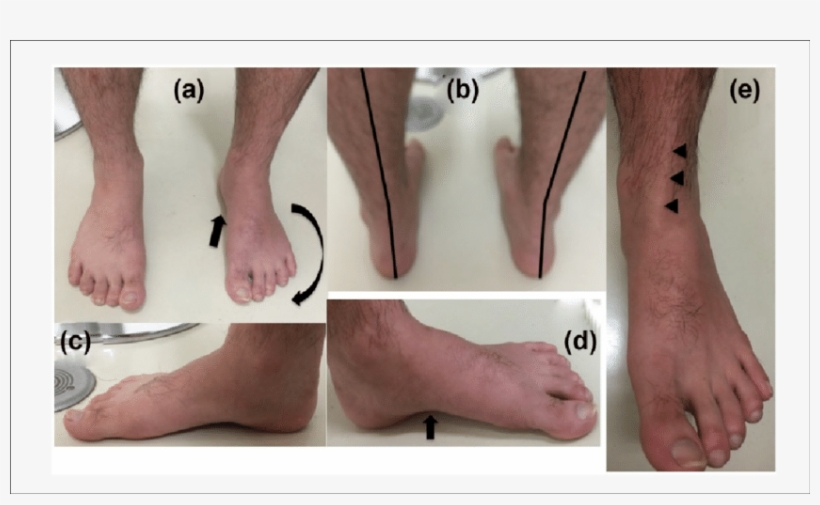 Preoperative Macroscopic Findings - Barefoot, transparent png #1041990