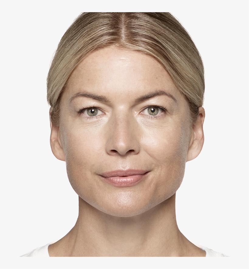 See Where Restylane® Products Can Help Reduce Your - Restylane, transparent png #1043403