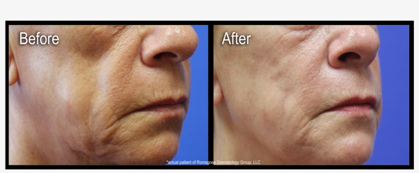 Are Injectable Gels Used To Restore Fullness And Volume - Scar, transparent png #1043989