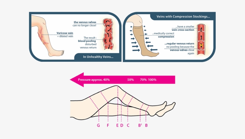 Traditionally, Patients With Varicose Veins Were Recommended - Conservative Treatment Of Varicose Veins, transparent png #1052160