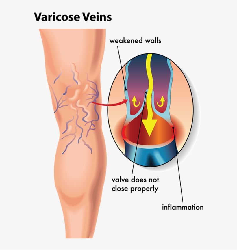 By Unsightly Veins Are Delighted With The Results They - Varicose Veins Diagram, transparent png #1052636