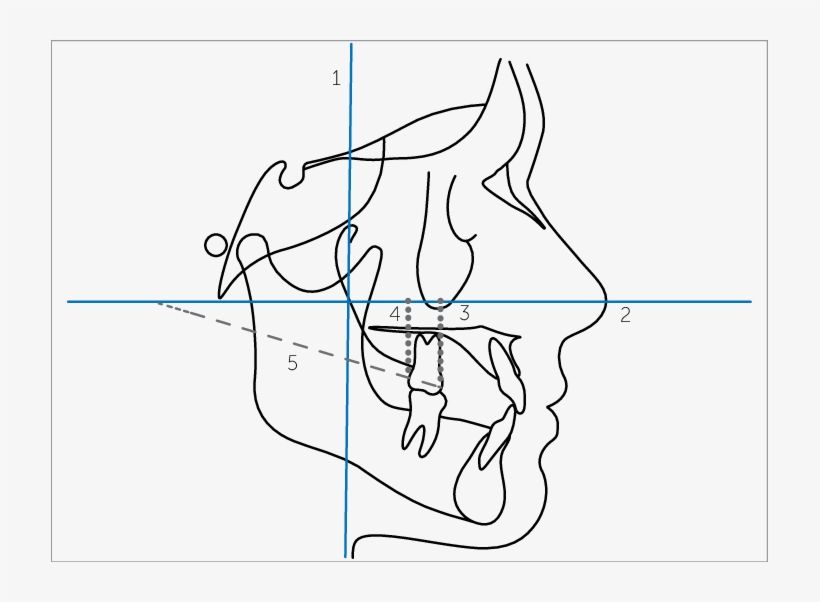 Lines Demarcated On The Lateral Teleradiograph - Line Art, transparent png #1062441