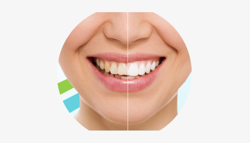 Teeth Whitening - Restorations Teeth, transparent png #1074079