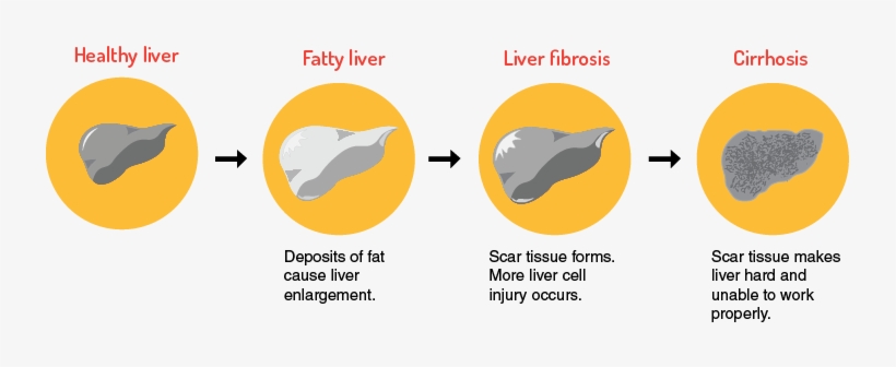 Causes - Fatty Liver Disease, transparent png #1152844