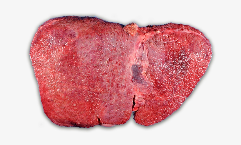The Progression Of Liver Disease - Wilson Disease, transparent png #1153410