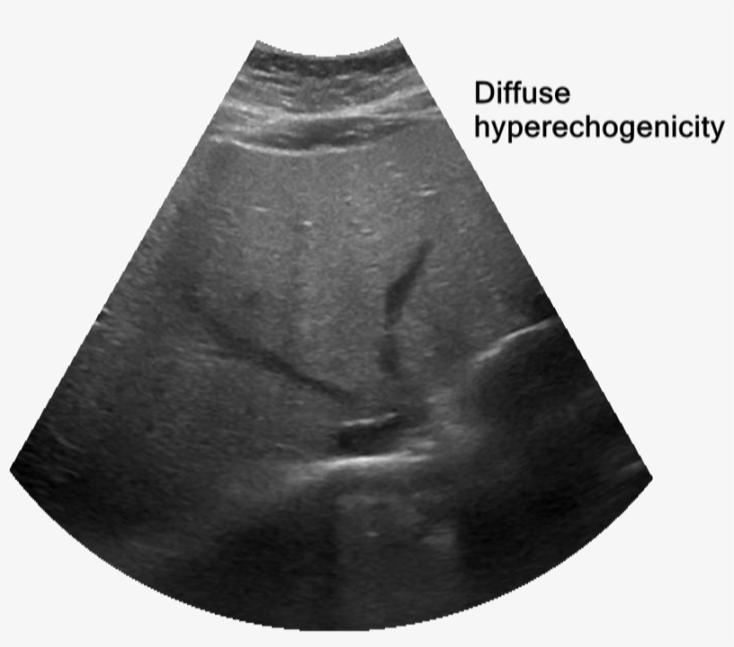 Fatty Liver - Miniskirt, transparent png #1153611