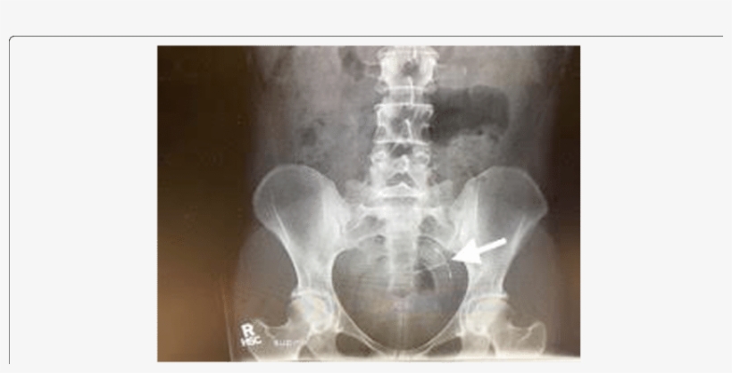 Abdominal Radiograph Of Pelvis With Arrow Pointing - X-ray, transparent png #1173584