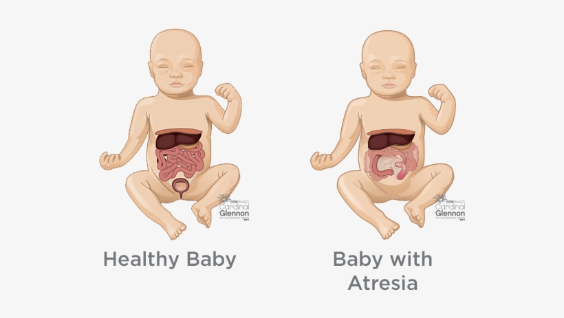 How Is It Managed And Treated During Pregnancy - Congenital Diaphragmatic Hernia, transparent png #1206566