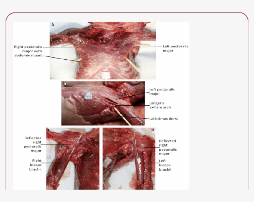 Anterior View Of The Chest Of Female 33 Week Old Fetus - Red Meat, transparent png #1207285