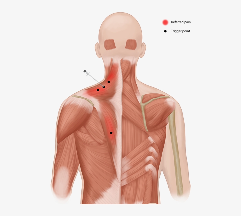 Trigger-pain - Trigger Points Injections, transparent png #1252944