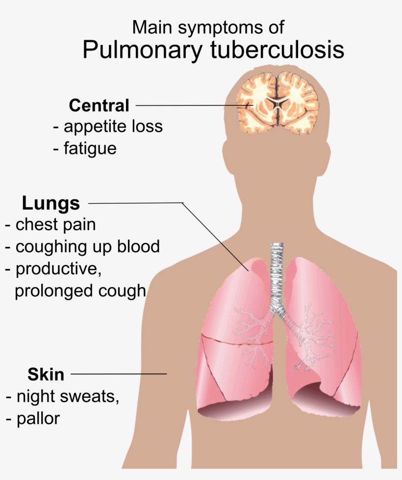 Pulmonary Tuberculosis Symptoms - Symptoms Of Aids, transparent png #1258644