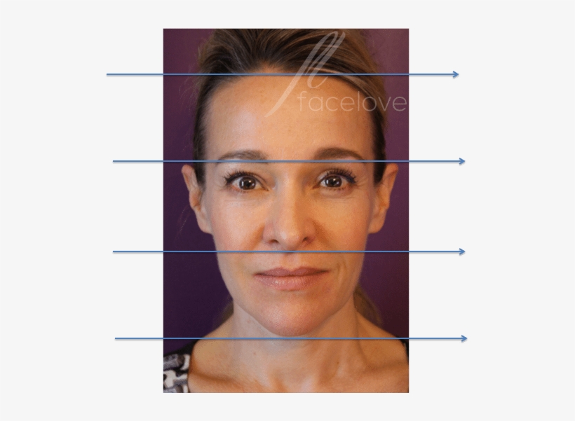 Lower Face Rejuvenation At Facelove - Can Cheek Filler Lift Jowls, transparent png #1274409
