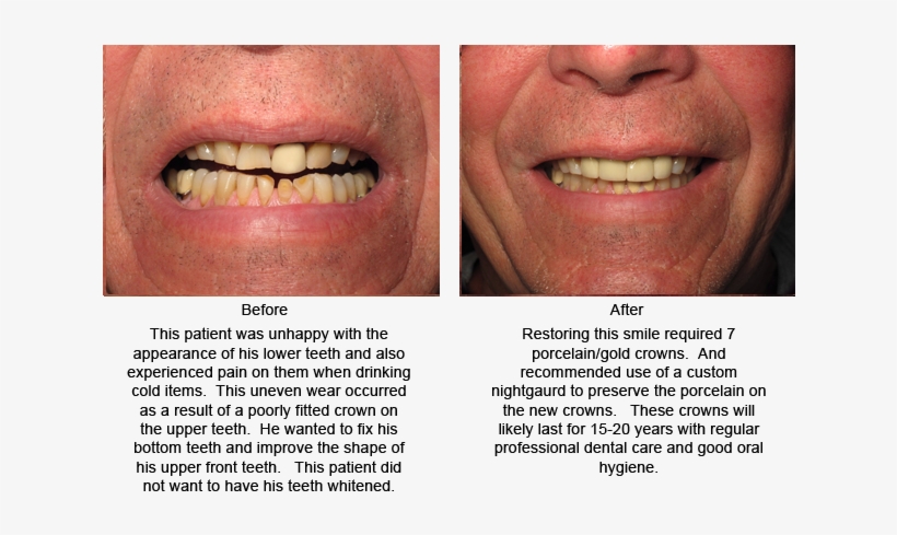 This Patient Desired A Brighter Smile In Minimum Time - Aggression, transparent png #1309383