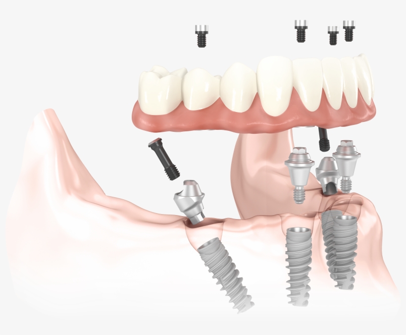 All On 4 Implants, Zygomatic Implants & Implant Dentures - All On 4 Implants, transparent png #1309531