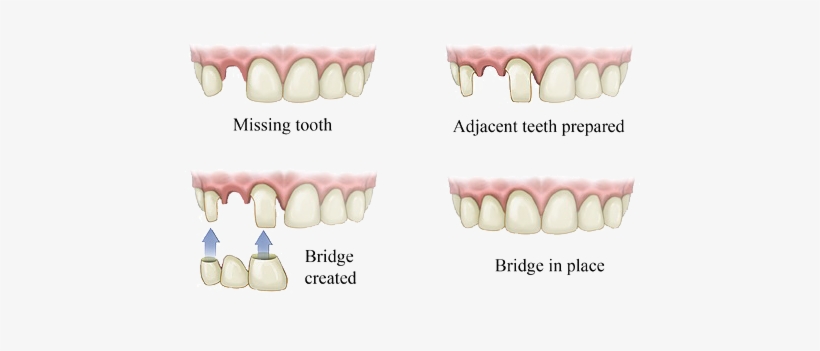 Service Img Bridge - Dental Bridge, transparent png #1309594