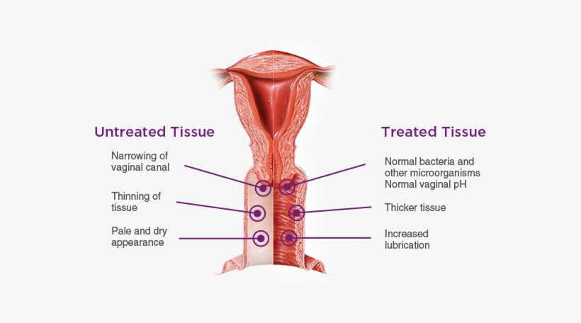 Vaginal Health Is An Important Part Of Your Overall - Vulvovaginal Atrophy, transparent png #1398827