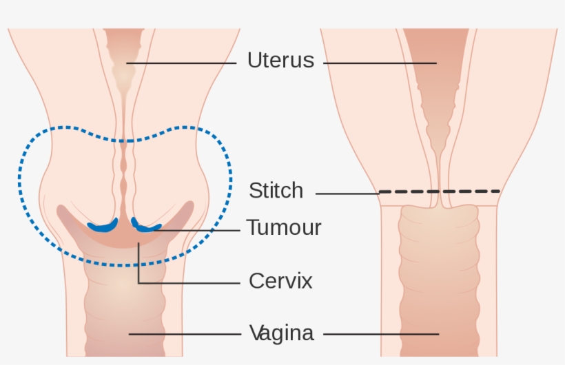 Removal Of Cervix Surgery, transparent png #1399027