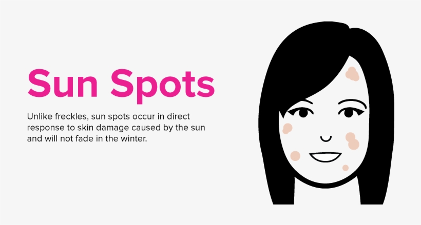 Because Of This, One Of The Best Ways To Reduce The - Freckles Caused By Sun, transparent png #140161