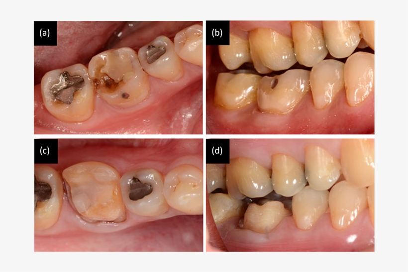 The Lower First Molar Has A Defective Restoration And - Macro Photography, transparent png #1447401