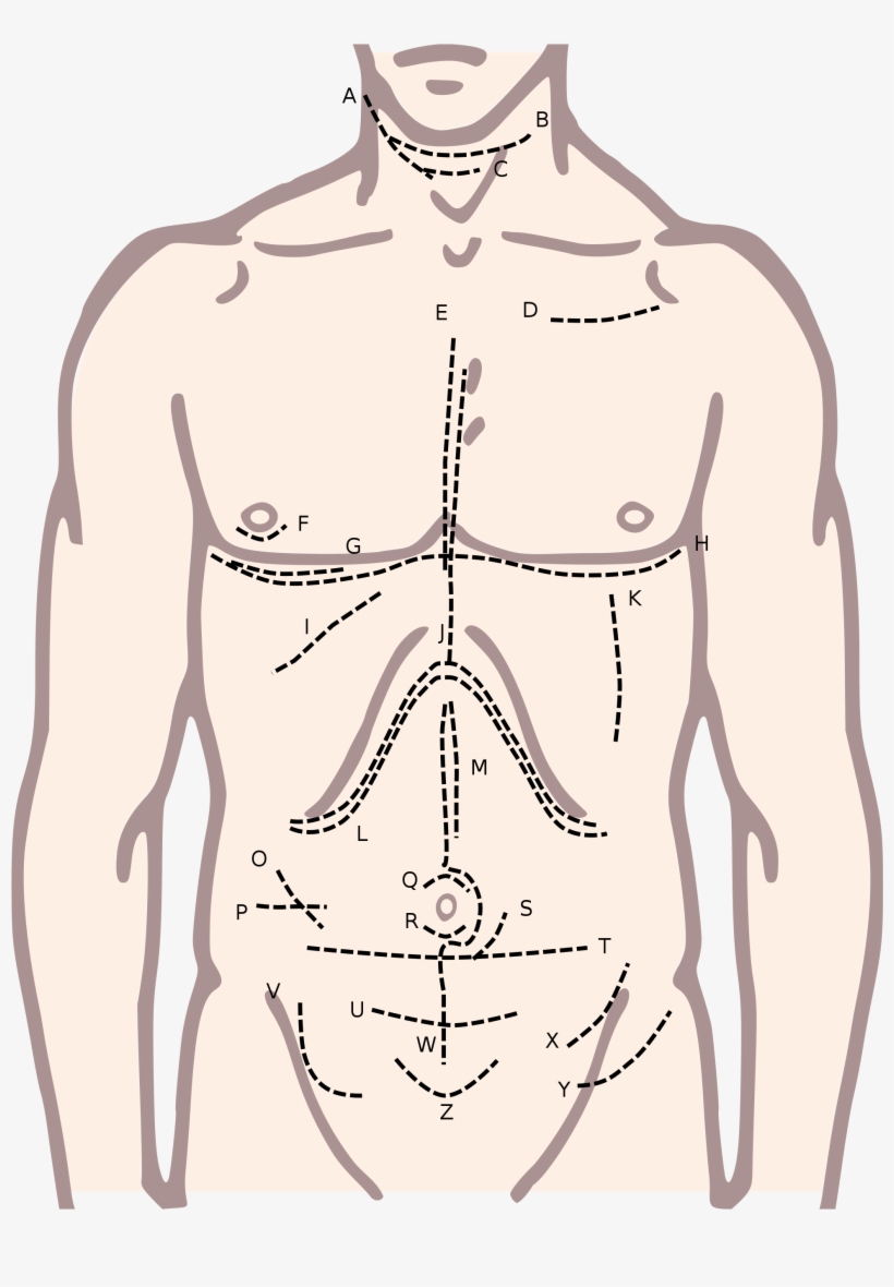Anatomy[edit] - Mcevedy Incision, transparent png #1455666