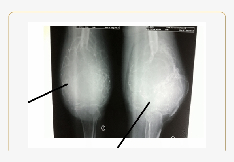 Ap And (b) Lateral Radiographs Of The Left Knee Joint - Osteolytic Lesion, transparent png #1570950