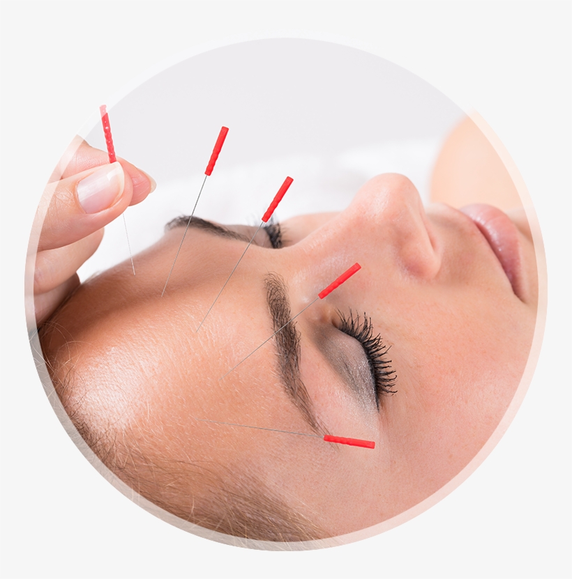 Louisville Acupuncture Treatment - Acupuncture Migraine, transparent png #1573372