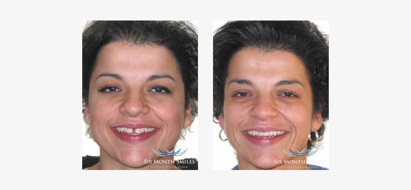 Prevnext - 6 Month Smiles Gaps, transparent png #1573516