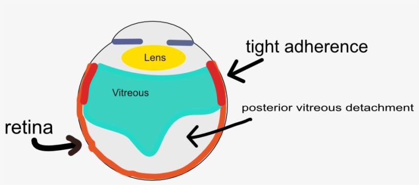 During The Process Of A Pvd, The Vitreous Rapidly Peels - Light Probe In Eye Surgery, transparent png #1576537