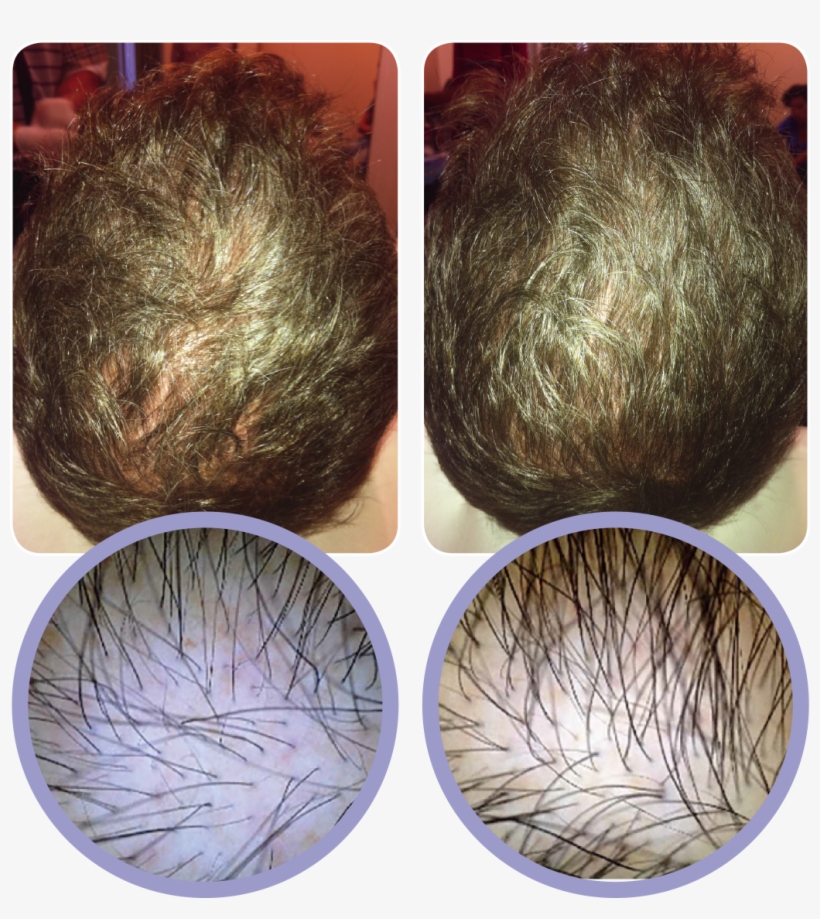Androgenic Alopecia A Prp® Injections Are Simple And - Prp Hair Before And After, transparent png #1580531