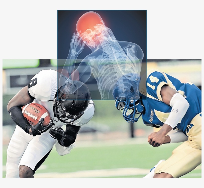 Concussion - Football Sport Related Concussion In The Young Athlete, transparent png #1660716