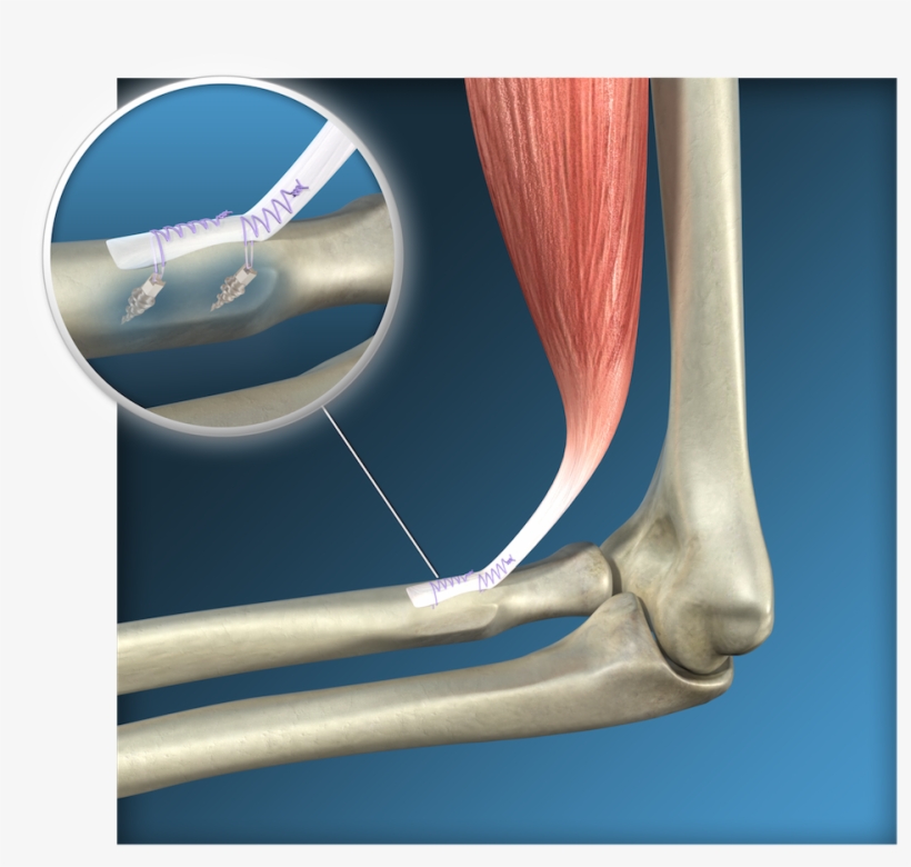 Endoscopic Distal Biceps Reinsertion Surgery, Toulouse - Rotura Del Tendon Distal Del Biceps, transparent png #1662506