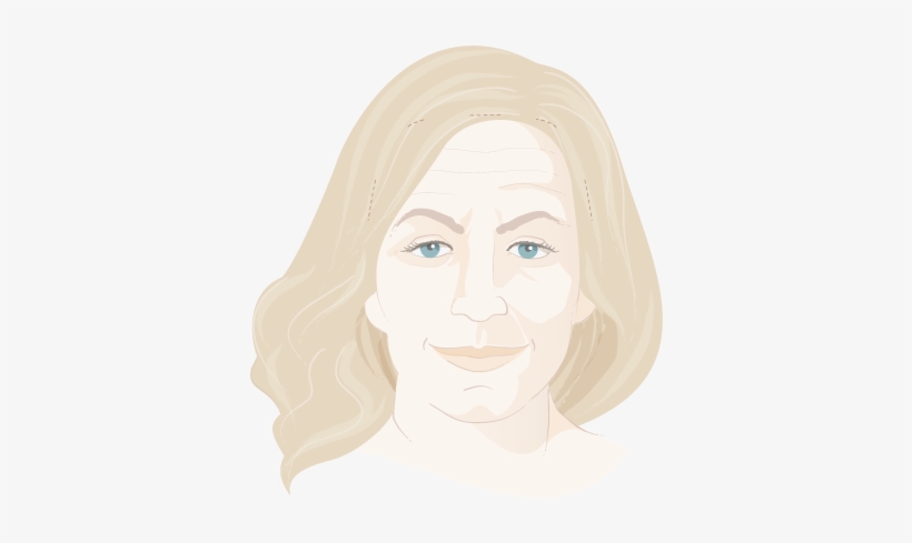Graphic Showing Woman's Face Before Brow Lift - Visual Arts, transparent png #1740824