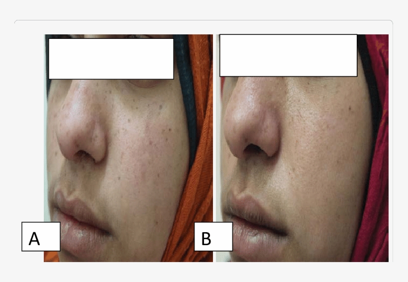 Female Patients 27 Years Old With Freckle Treated With - Q Switch Yag Laser For Freckles, transparent png #188333