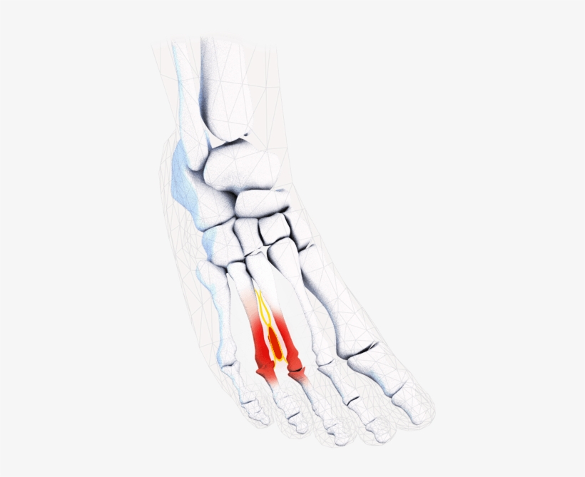 Morton's Neuroma - Radiography, transparent png #1833202