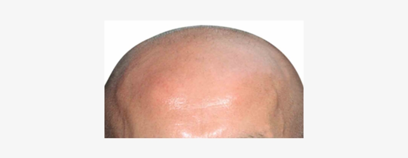 Baldhead - Hair Loss, transparent png #1838632