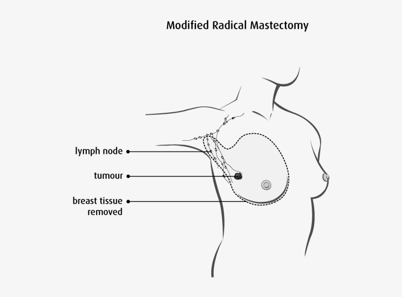 Diagram Of A Modified Radical Mastectomy - Muscle Between Boob And Armpit, transparent png #1845034