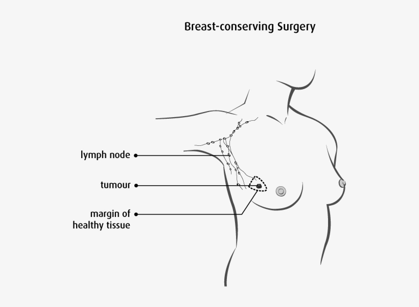 Diagram Of Breast Conserving Surgery - Surgery In Breast Cancer, transparent png #1845082
