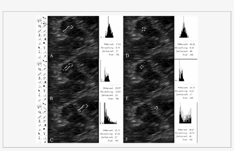 Data Obtained By Computer-aided Quantification Of Echogenicity - River, transparent png #1868284