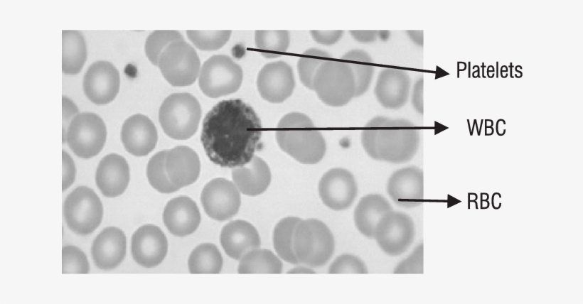 A Sample Blood Smear Showing Rbc, Wbc, Platelets Table - Pernicious Anemia Vs Normal, transparent png #1927821