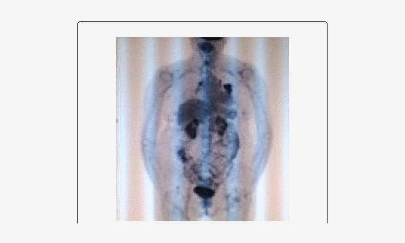 Follow Up Pet/ct Images In Transaxial And Multiple - Painting, transparent png #2009436