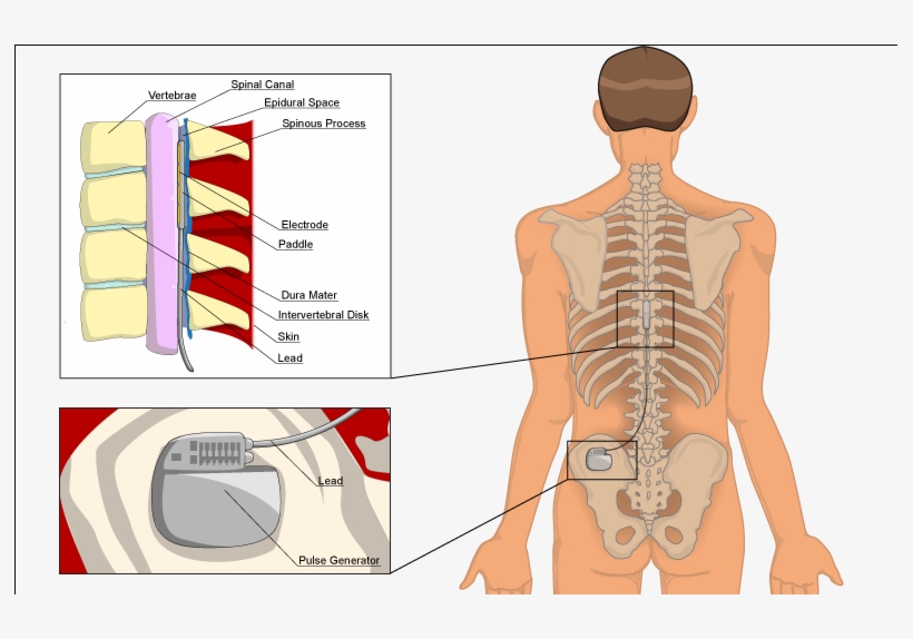 Spinal Cord Stimulation - Spinal Stimulation Pain, transparent png #2050028