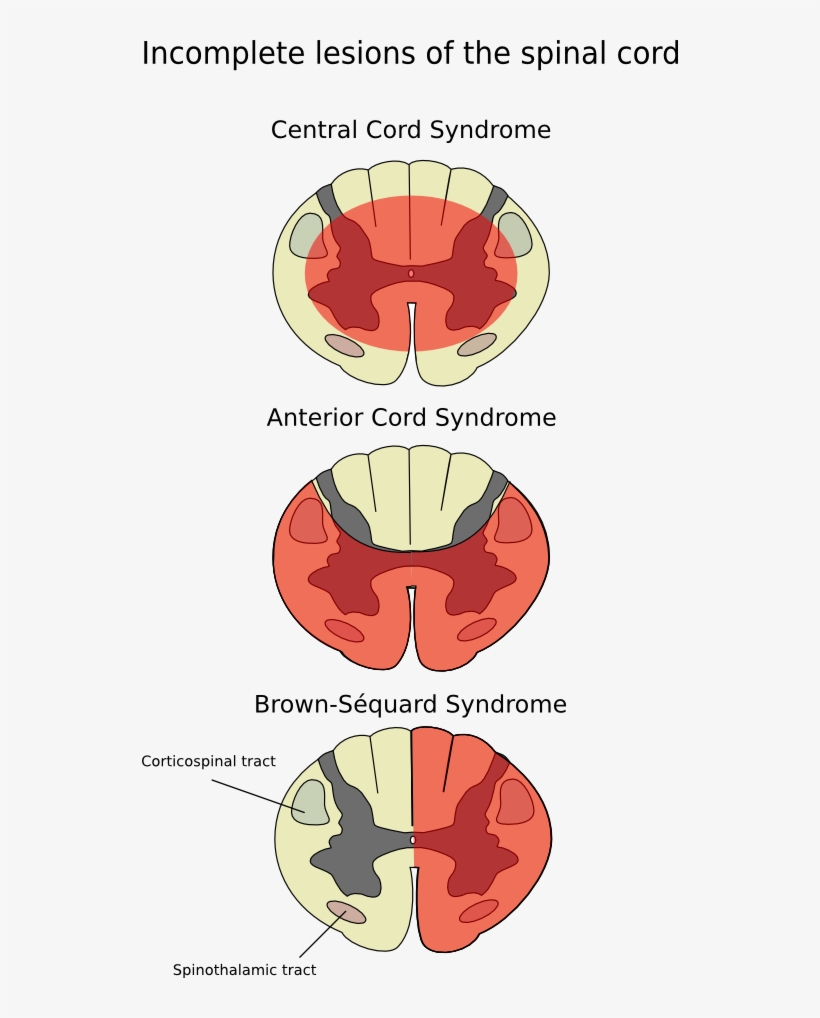 File - Cord-en - Anterior Spinal Syndrome, transparent png #2050073