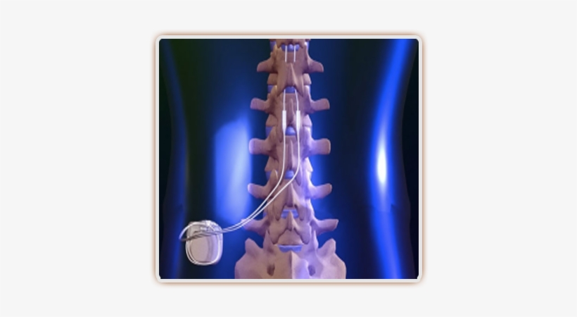 In A Lot Of Post-laminectomy Cases, A Spinal Cord Stimulator - Spinal Cord Stimulators, transparent png #2050240