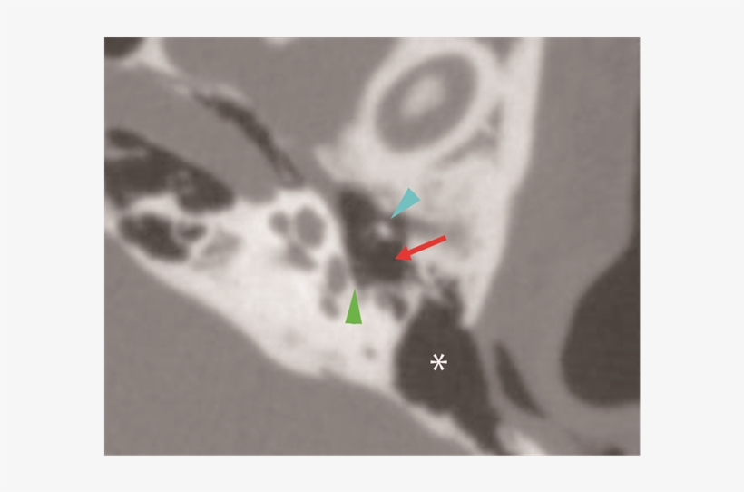 High-resolution Computed Tomography Revealed An Ambiguous - Computed Tomography, transparent png #2064225
