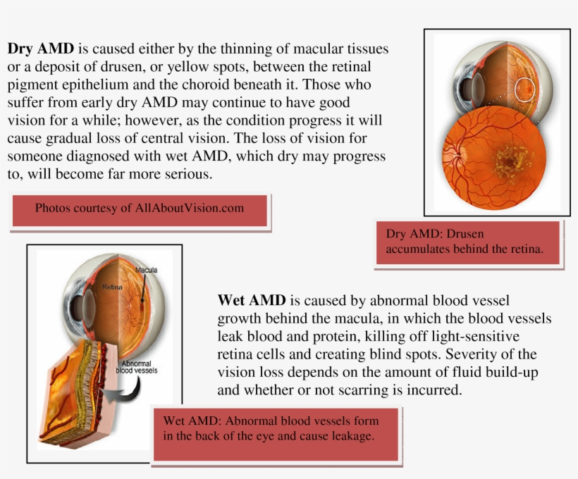 Eyeball Chart - Age Related Macular Degeneration, transparent png #2130177