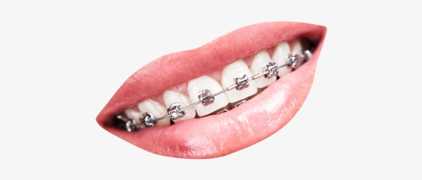 Teeth With Braces Png Transparent Image - Teeth Braces Png, transparent png #2148076