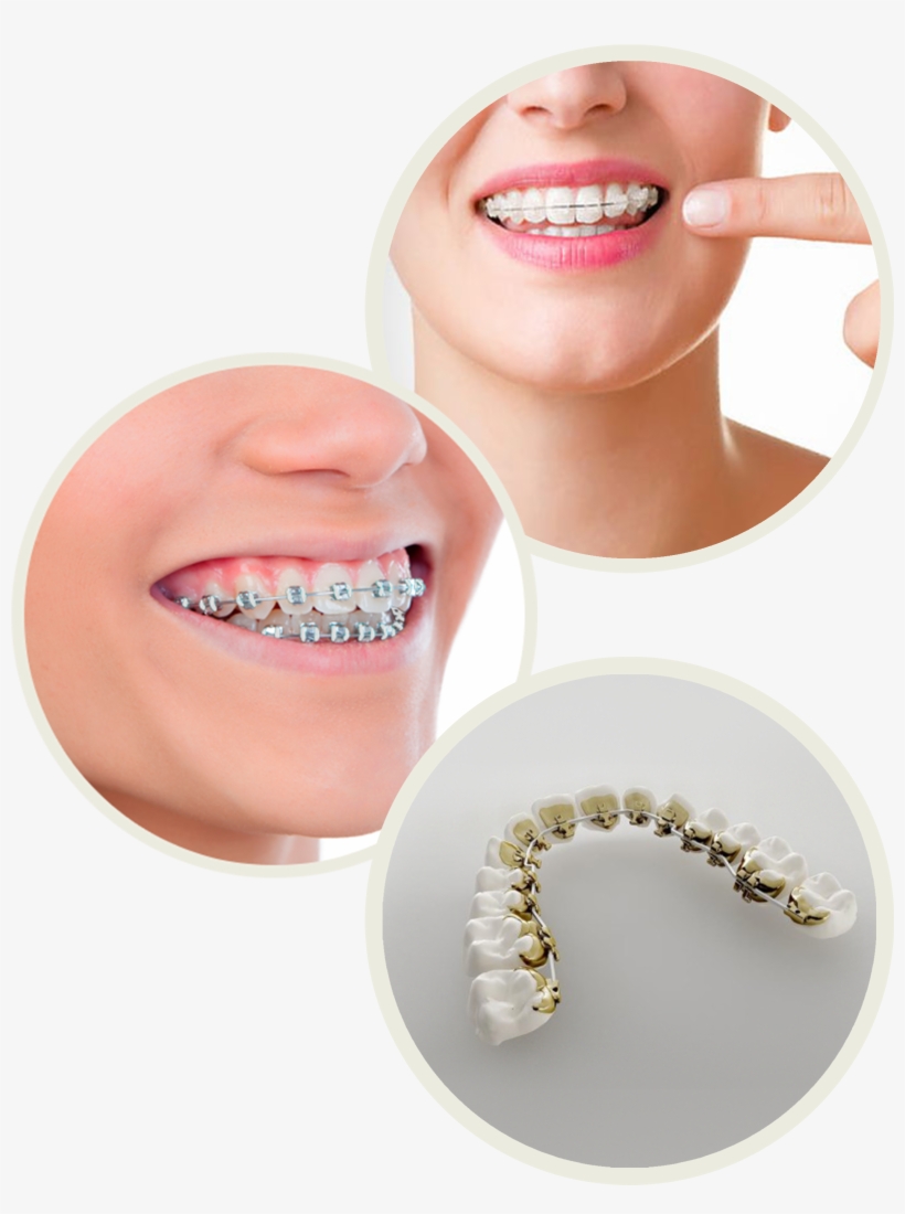 International Dental Center In Puerto Vallarta - Elastice Albe Aparat Dentar, transparent png #2148173