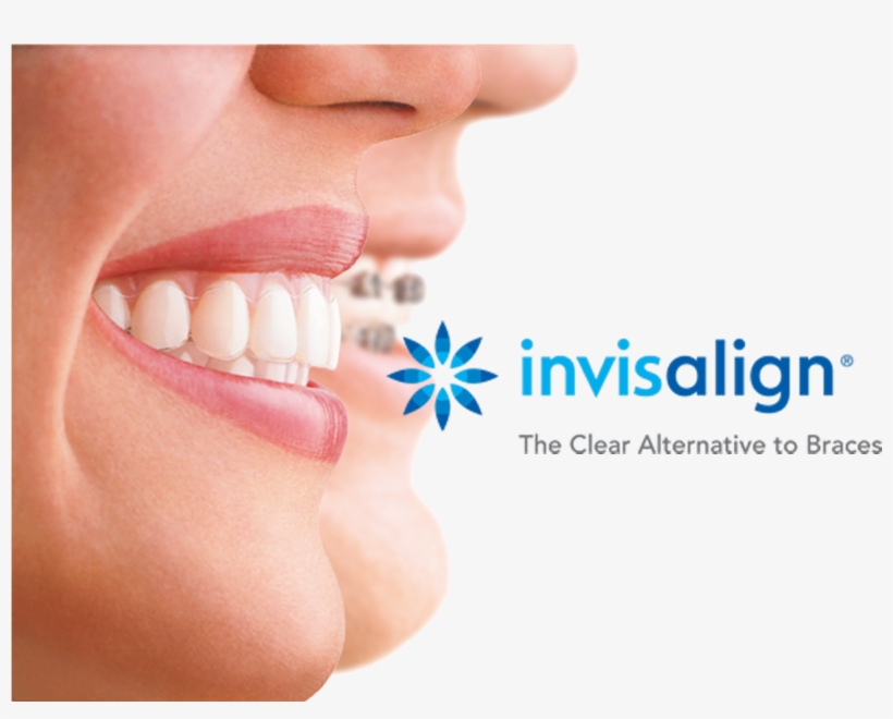 //cdn2 - Hubspot - - Clear Aligners, transparent png #2148250